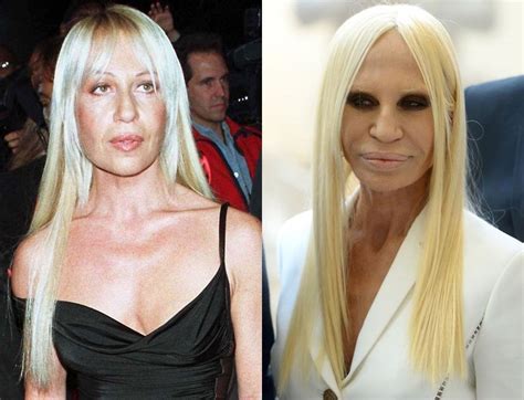 donatella versace bella|donatella versace before and after surgery.